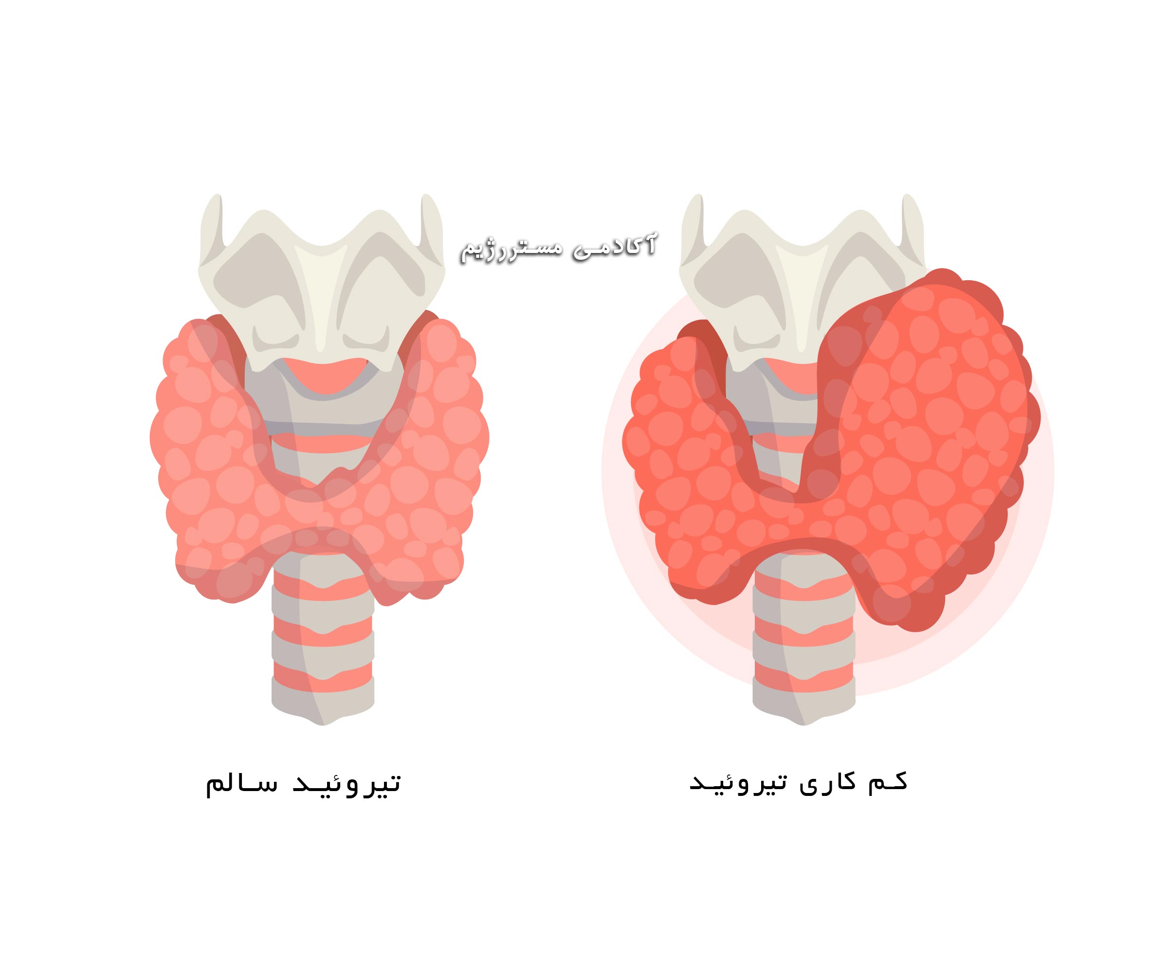 لاغری سریع برای کم کاری تیروئید