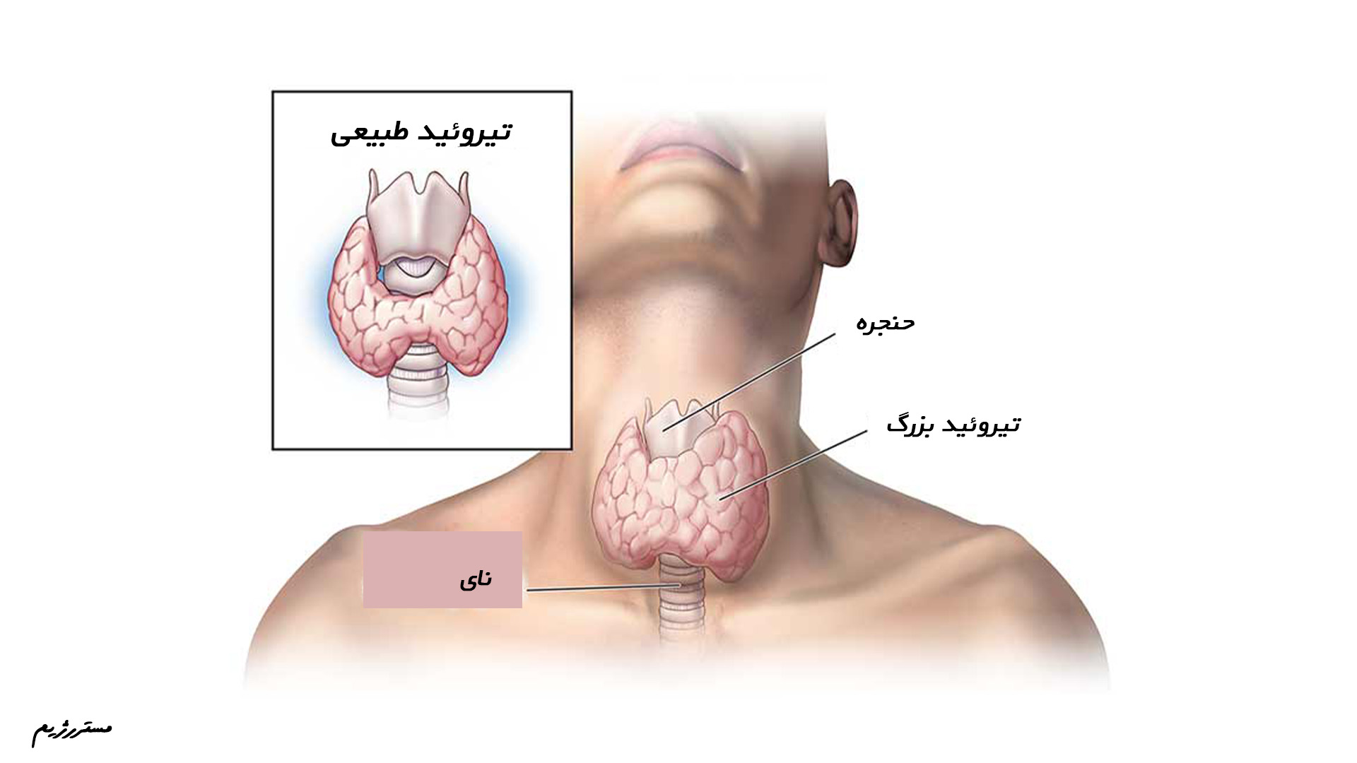 تفاوت تیروئید کم کار و تیروئید طبیعی