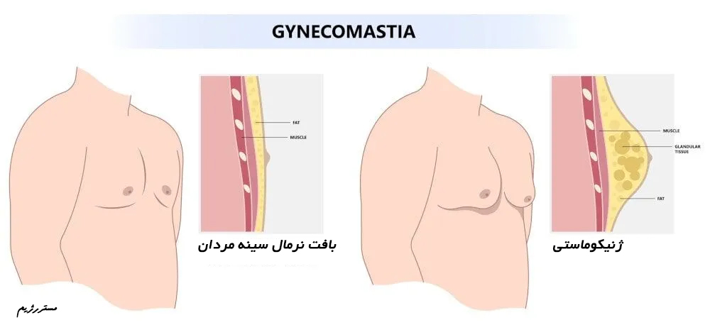 درمان ژنیکوماستی