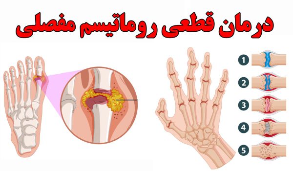 درمان روماتیسم مفصلی