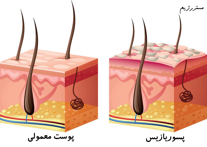 تفاوت پوست معمولی و پسوریازیس