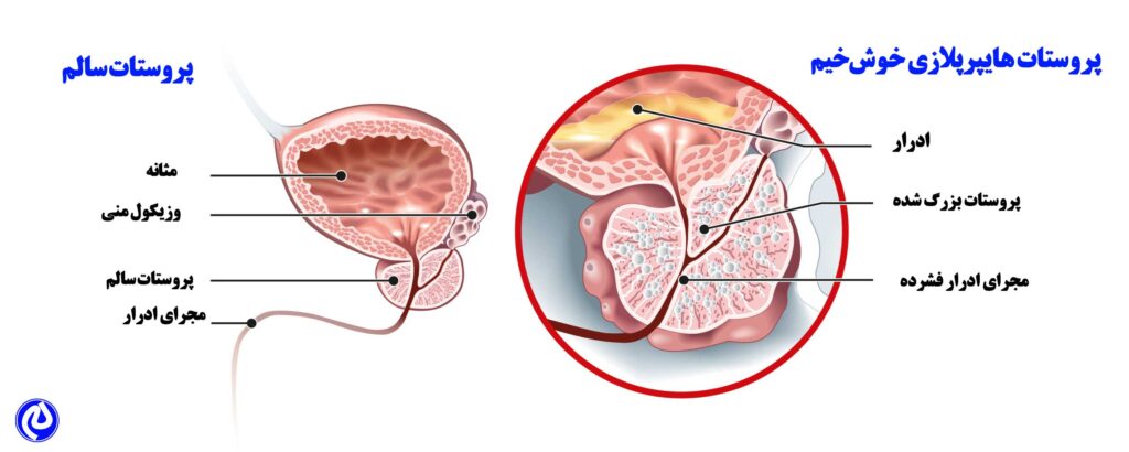 تصویر تفاوت بین پروستات هایپرپالازی و پروستات سالم را نشان میدهد