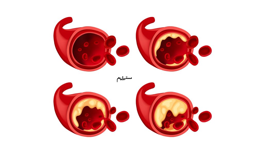 تصویر چربی خون در مراحل مختلف