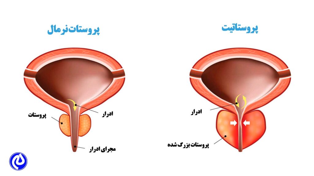 تفاوت پروستات نرمال و پروستاتیت